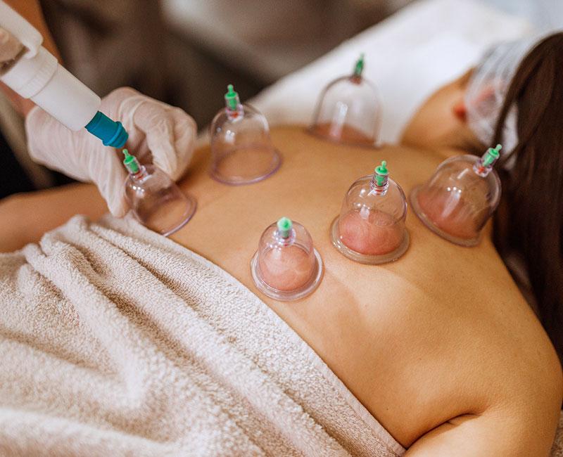 Cupping therapie