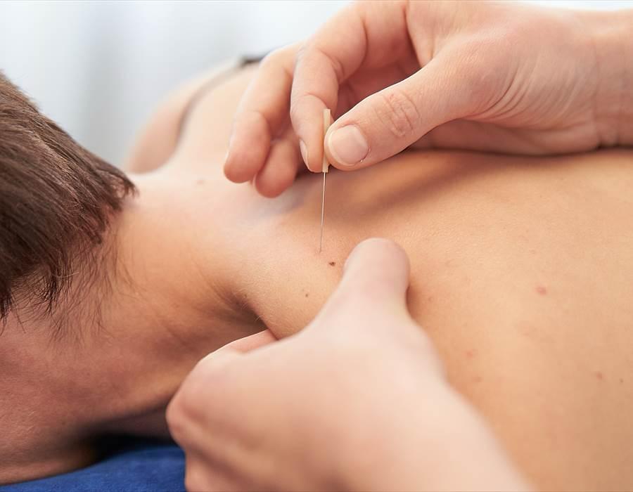 Dry needling